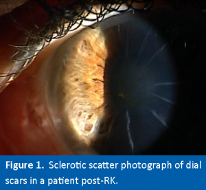 Radial Scars Post-RK Patient