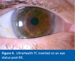 Figure4. UH-FC on Post-RK Eye