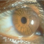 keratoconus_conical_cornea-150x150